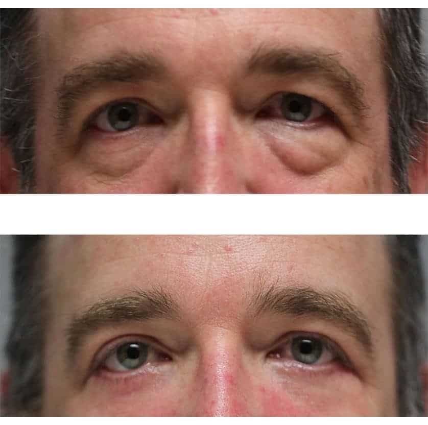 before and after Cosmetic Eyelid Surgery Denver CO
