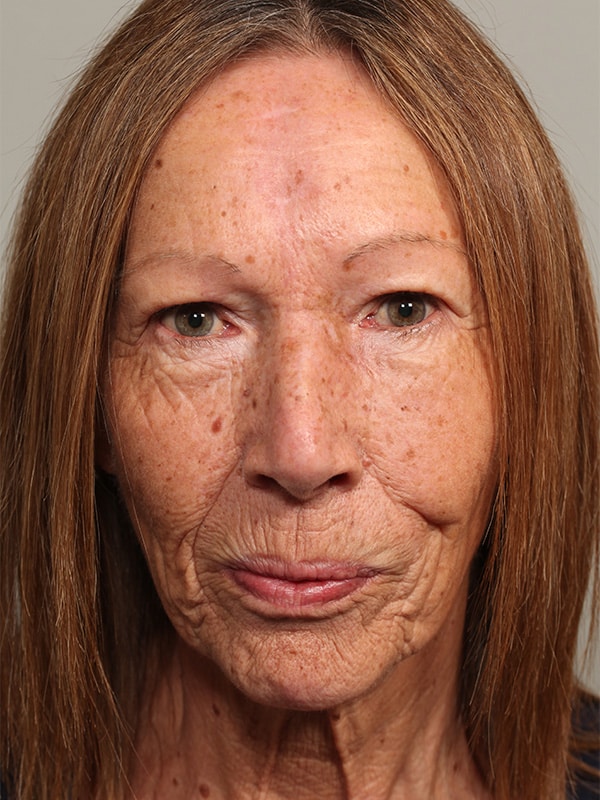 Lower Eyelid Reconstruction Archives - Fante Eye & Face Centre